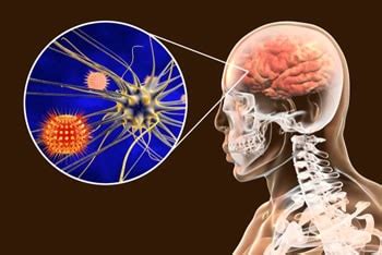 meningite virale cura